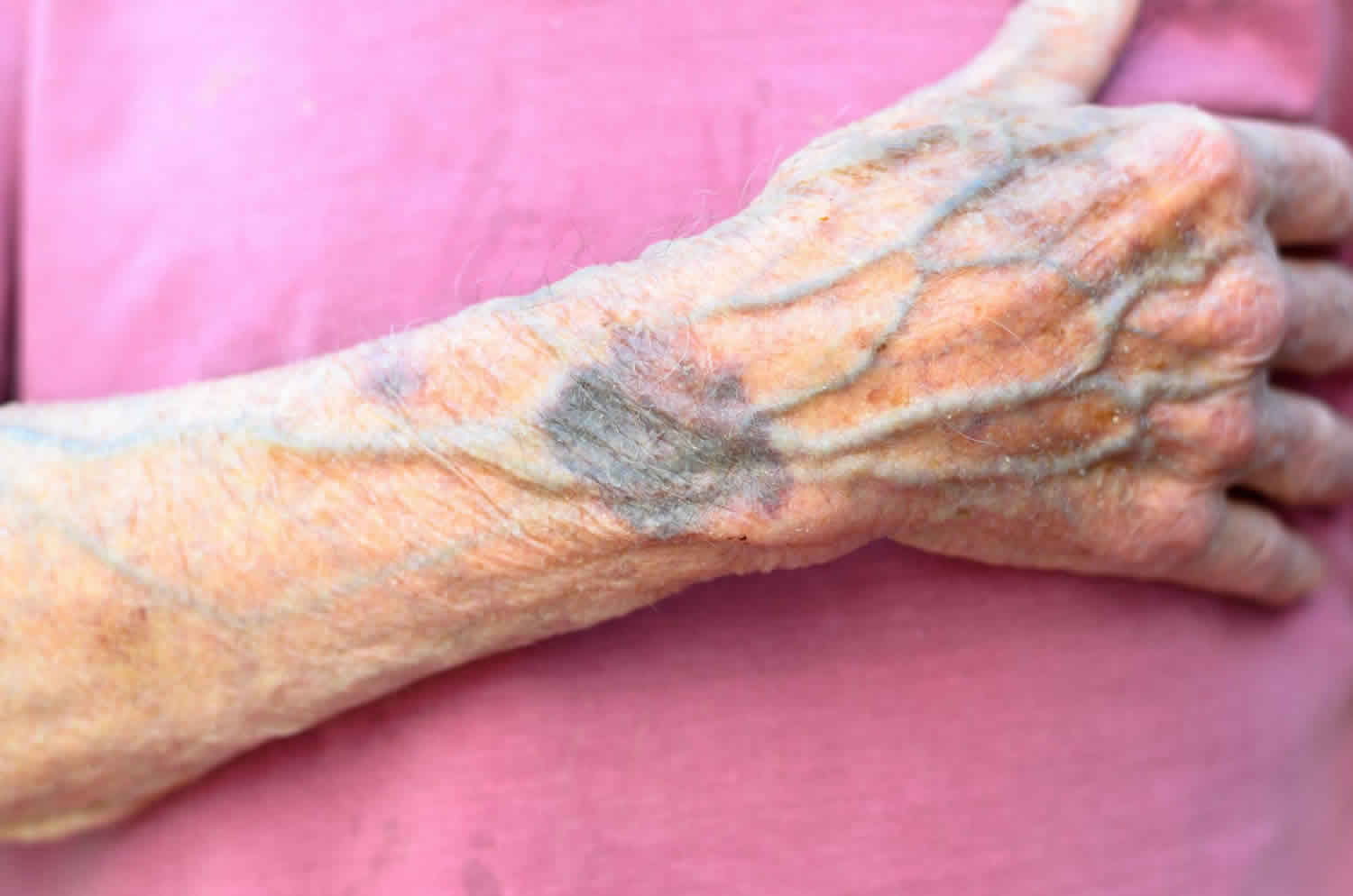 how-to-treat-enlarged-hand-veins