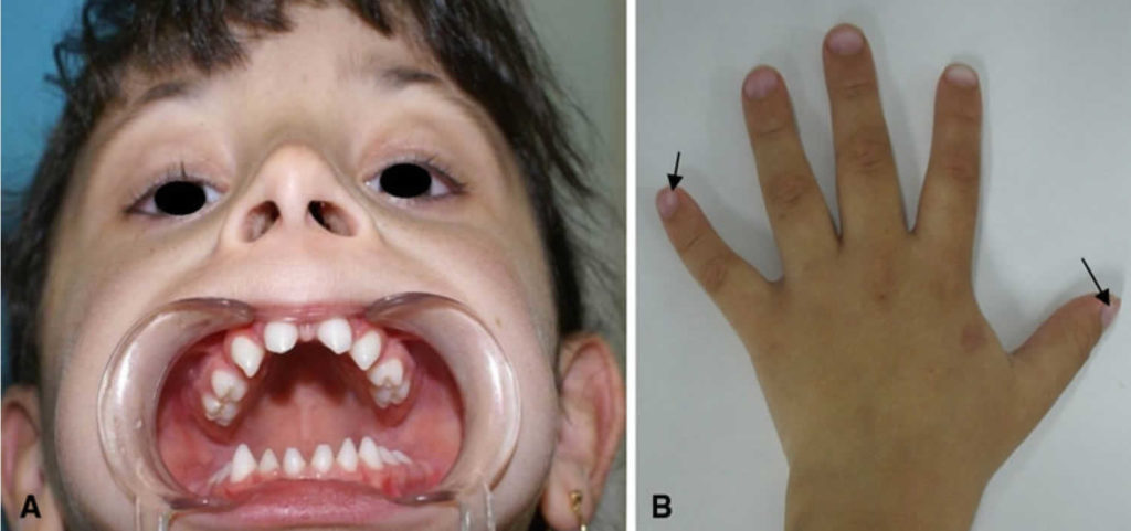 Hypohidrotic ectodermal dysplasia causes, symptoms, diagnosis & treatment