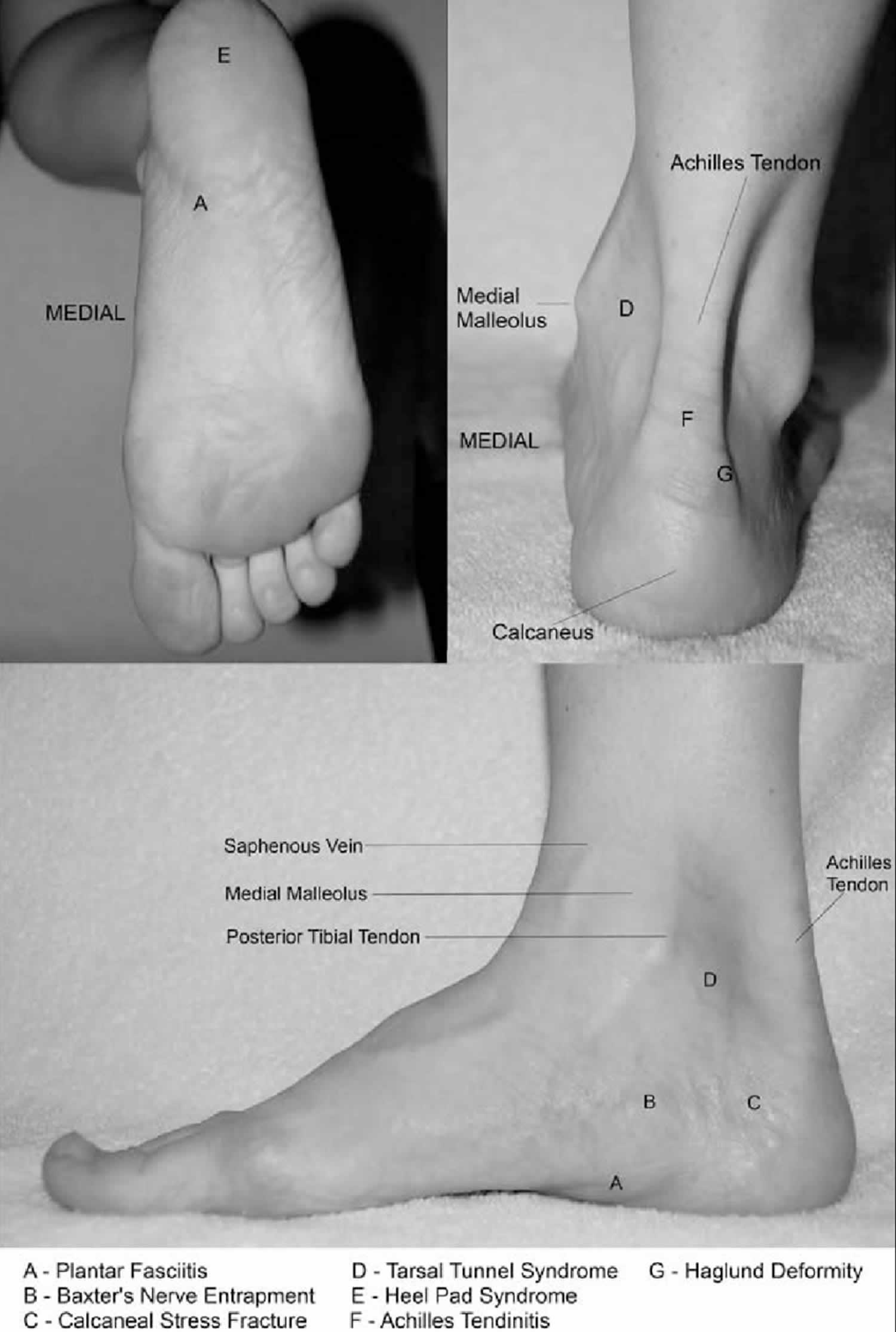 inflamed heel pad