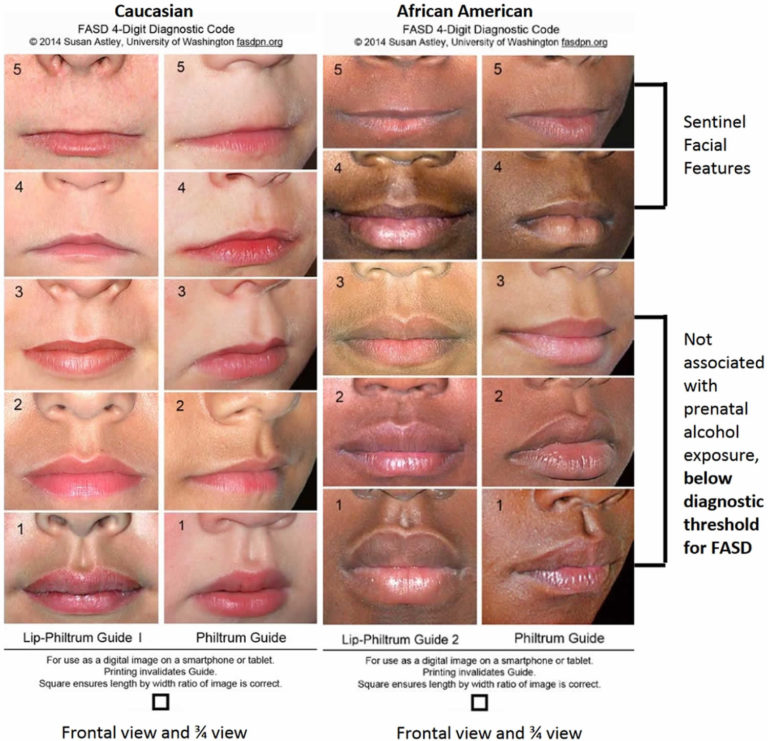 Philtrum of lip, causes of smooth philtrum, long or short philtrum