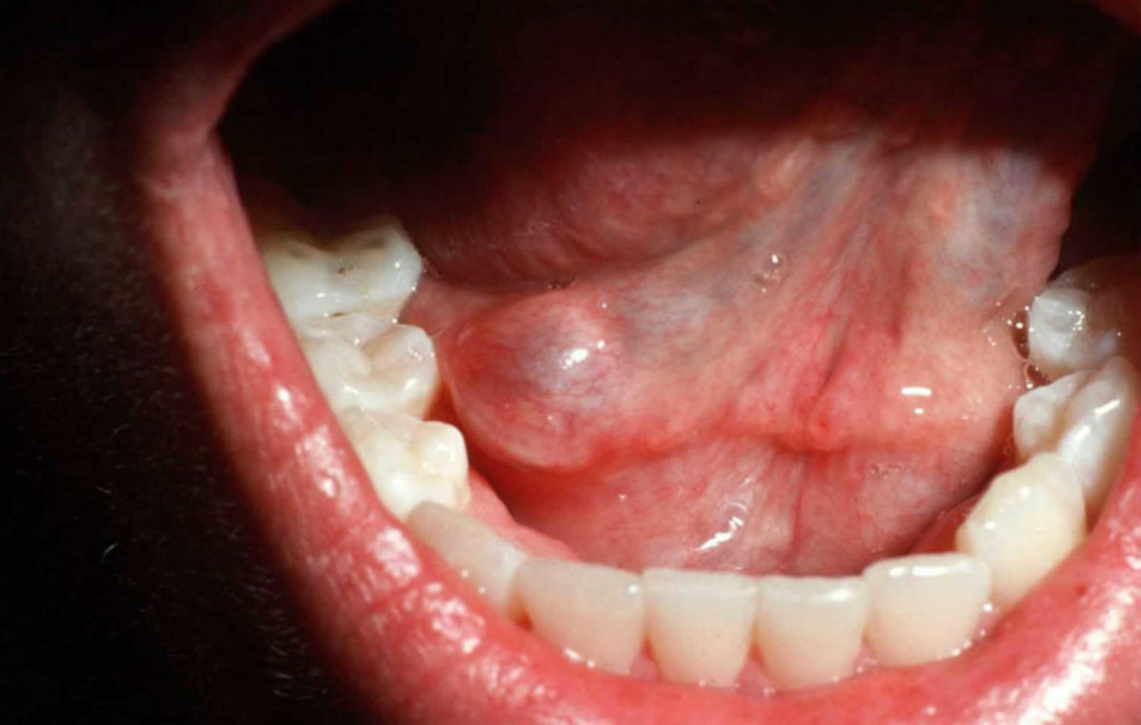 Oral mucocele causes, symptoms, diagnosis & treatment