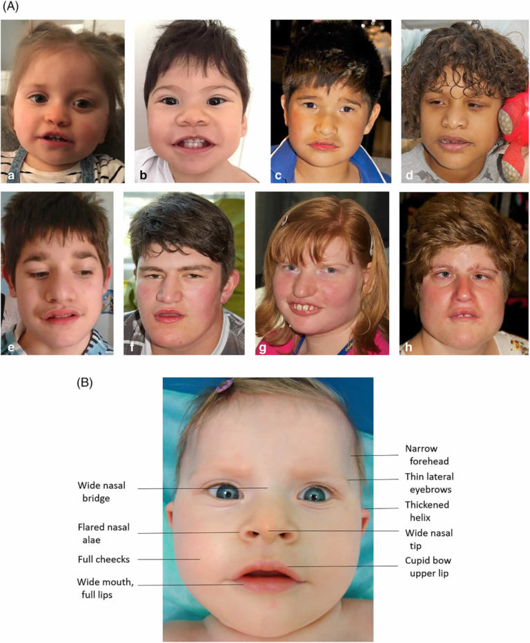 Pitt Hopkins syndrome causes, signs, symptoms, diagnosis & treatment