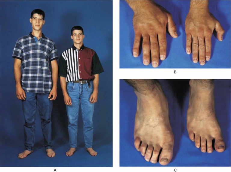 Gigantism causes, symptoms, diagnosis & treatment