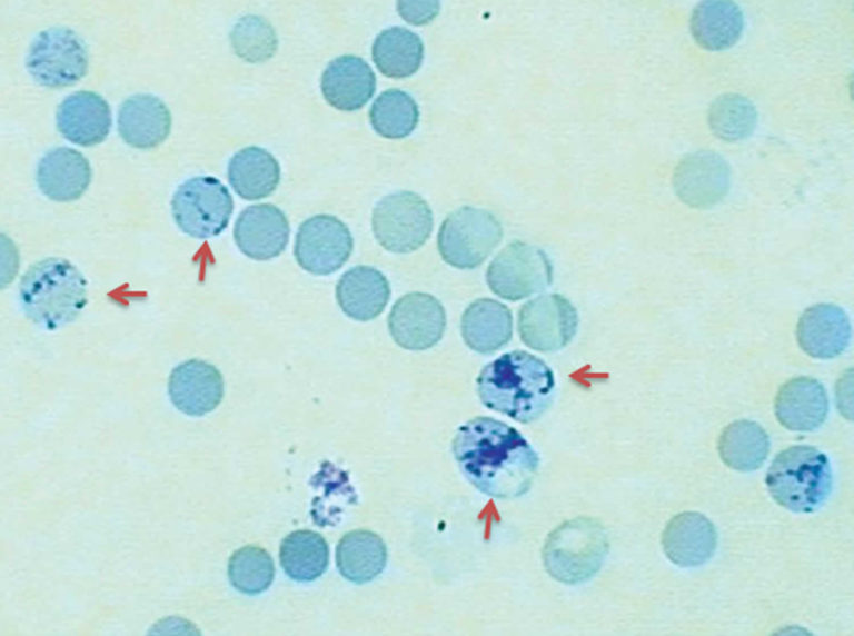 Reticulocytosis definition, causes, diagnosis & treatment