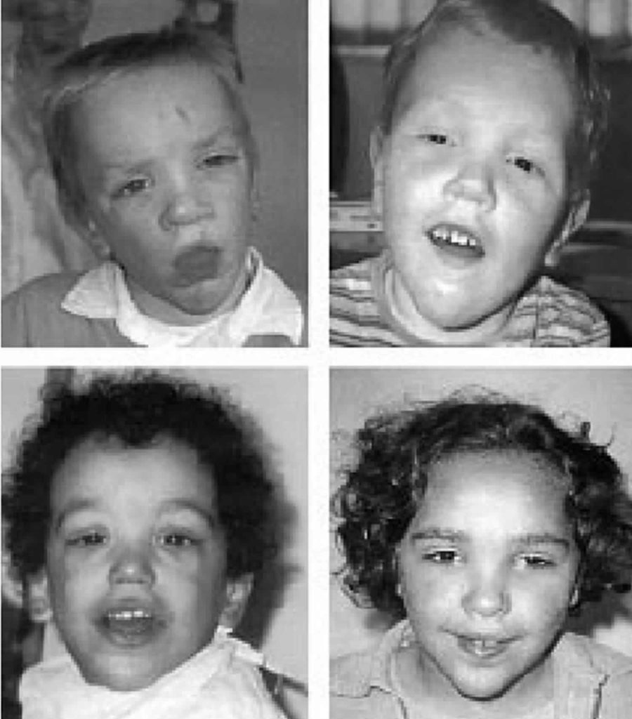 Sotos syndrome causes, symptoms, diagnosis, treatment & prognosis