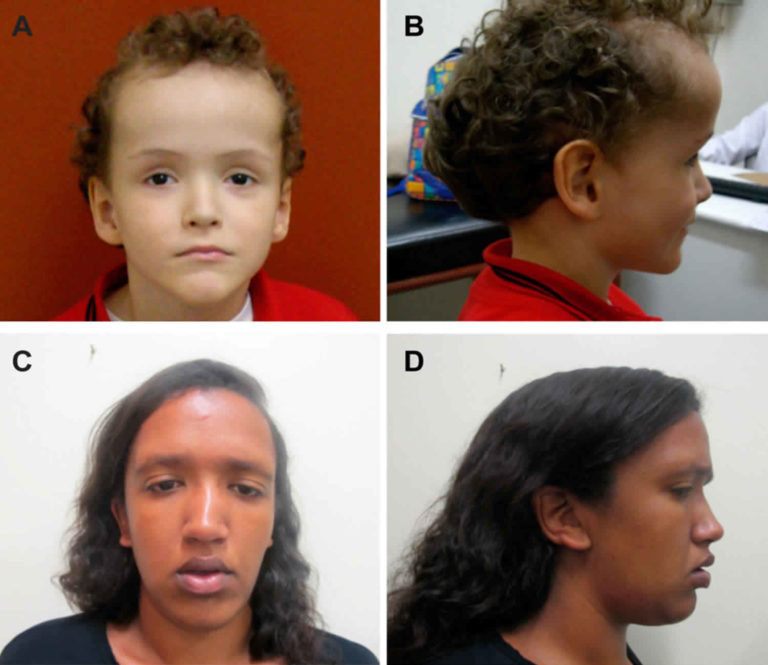 Sotos syndrome causes, symptoms, diagnosis, treatment & prognosis