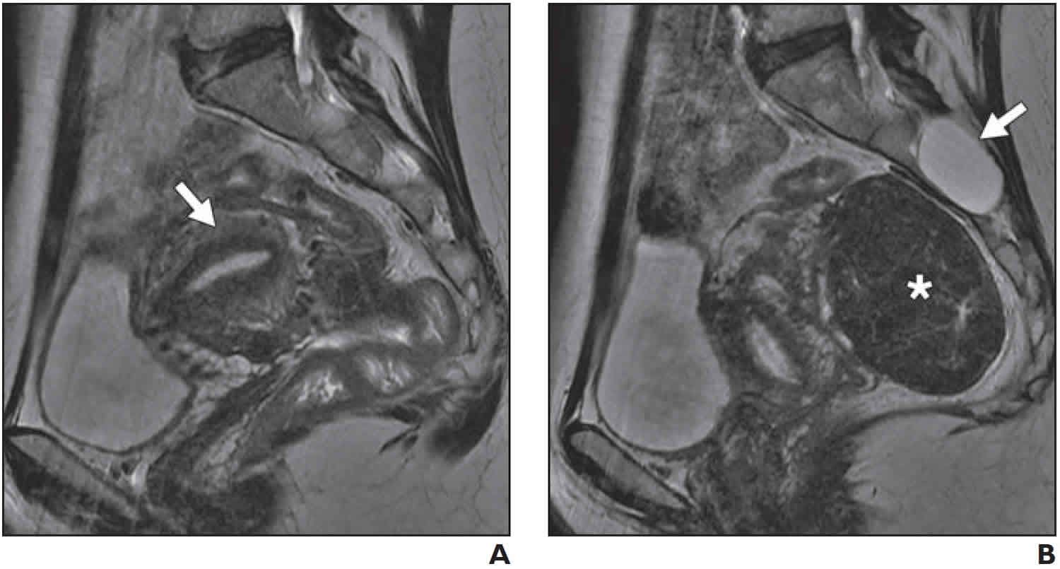 PDF) Acute Urinary Retention Due to an Incarcerated Retroverted Gravid  Uterus