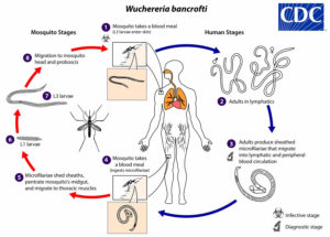 Wuchereria bancrofti infection, life cycle, symptoms, diagnosis & treatment