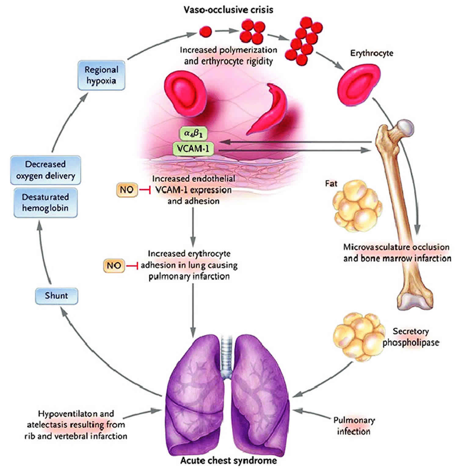 acute-chest-syndrome-causes-symptoms-diagnosis-treatment-prognosis