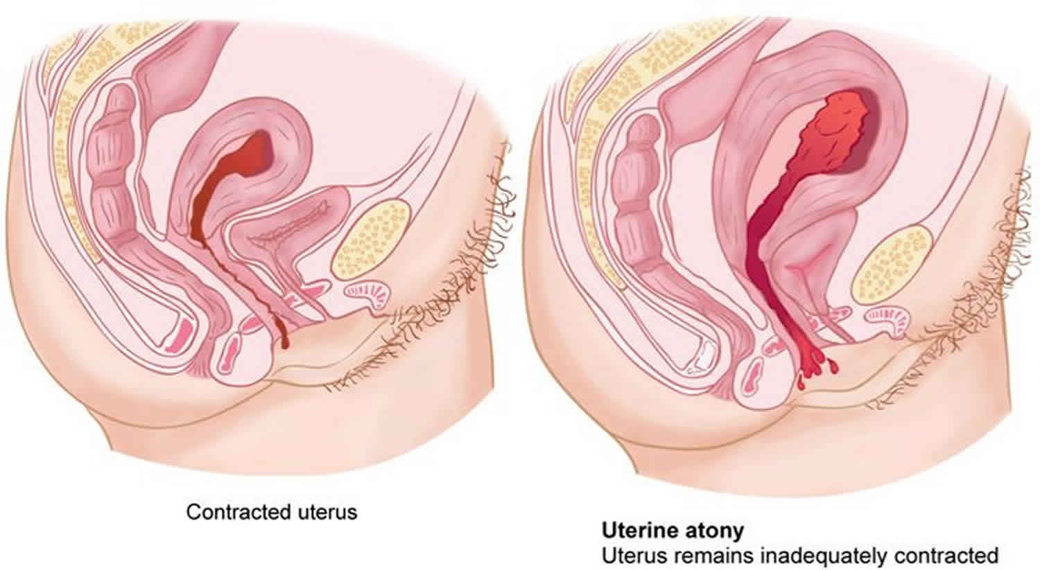 Boggy Uterus Boggy Uterus After Birth Causes Diagnosis Treatment Prognosis