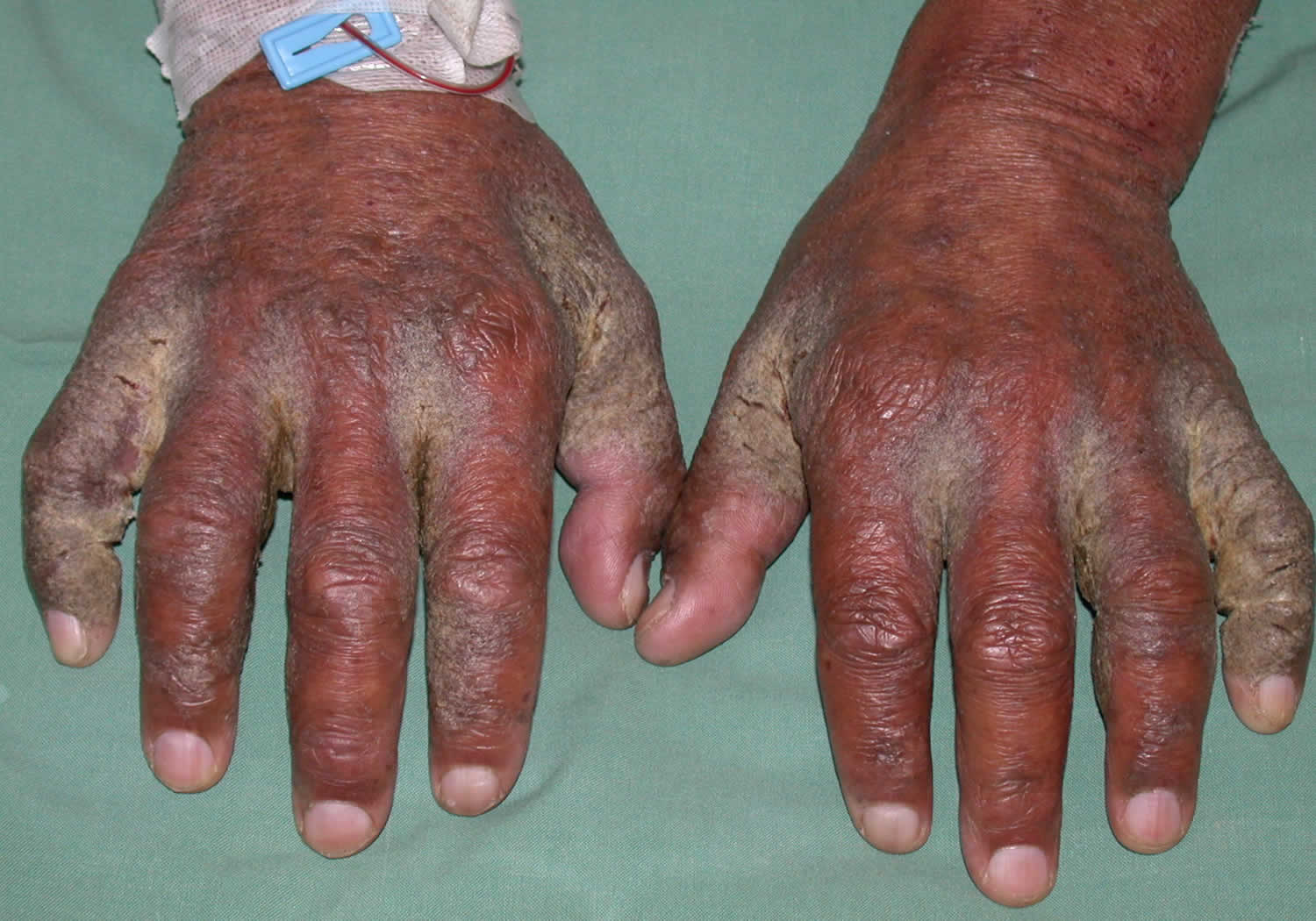 Scabies | Primary Care Dermatology Society | UK