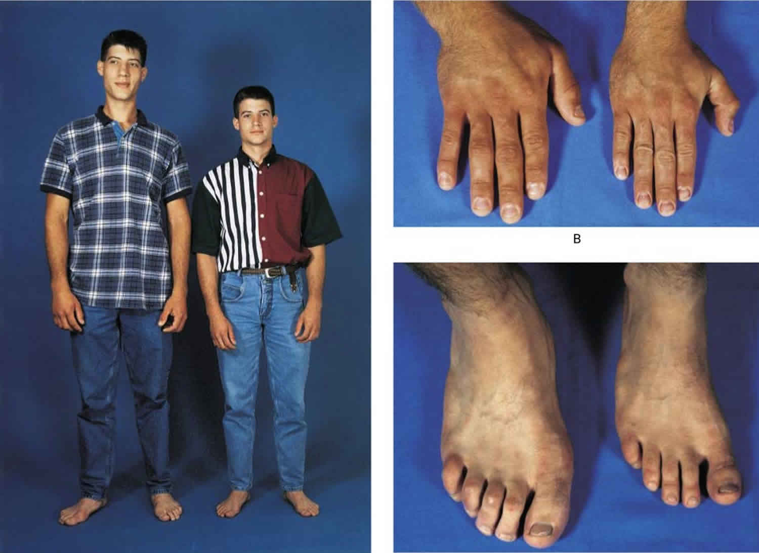 Gigantism - Pictures