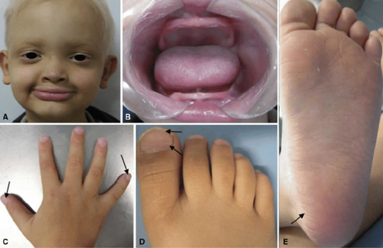 hypohidrotic-ectodermal-dysplasia-causes-symptoms-diagnosis-treatment