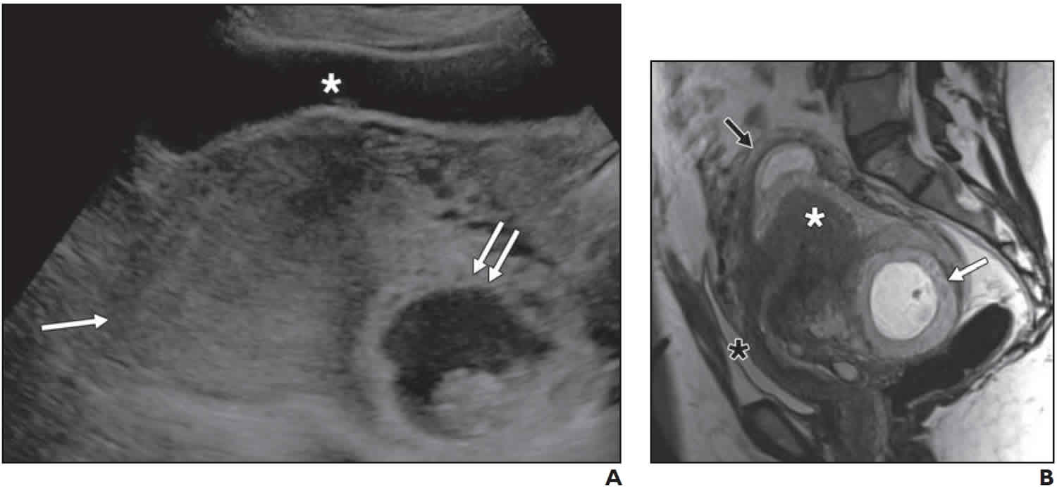 Acute urine retention in early pregnancy resulting from fibroid  incarceration: proposition for management.