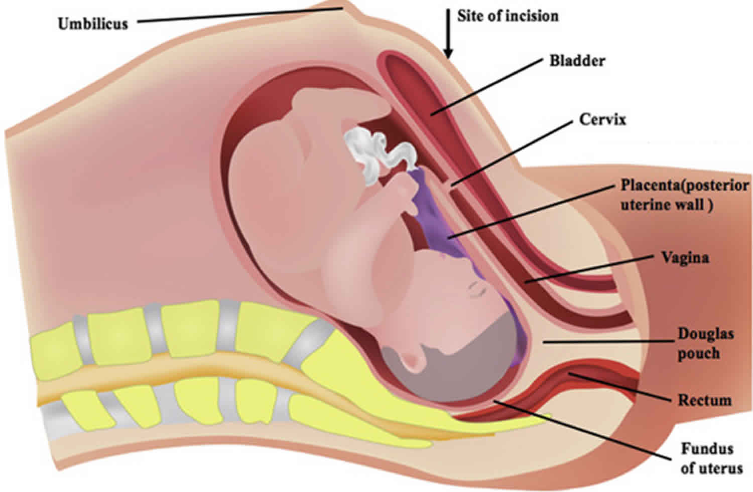 What are causes & symptoms of incarcerated uterus. 