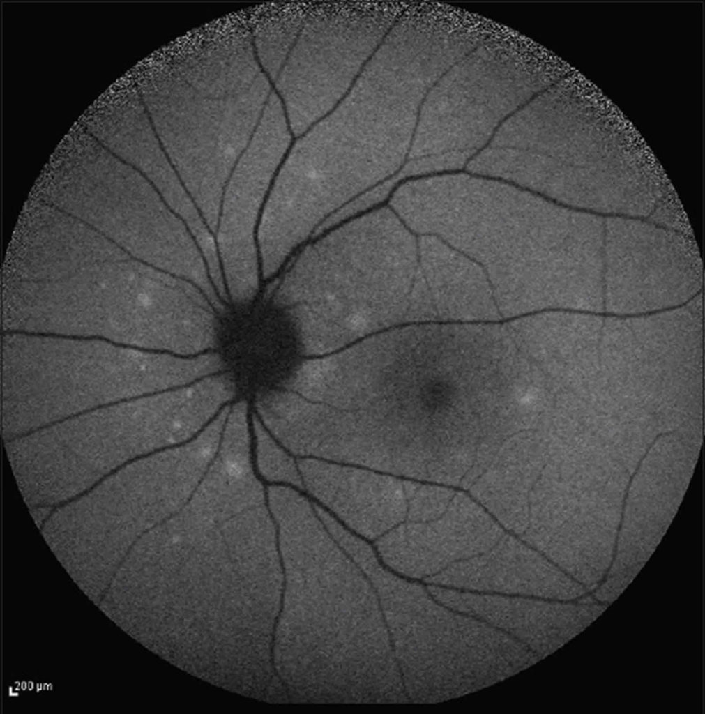 Multiple evanescent white dot syndrome causes, symptoms, diagnosis ...