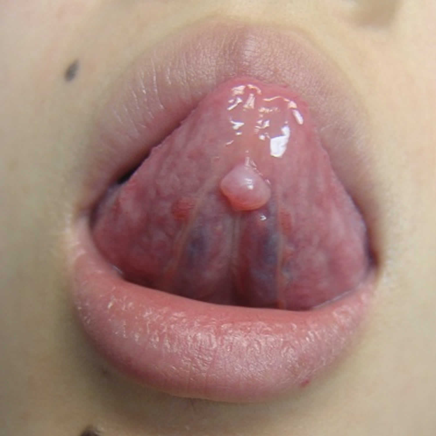 mucocele under tongue.