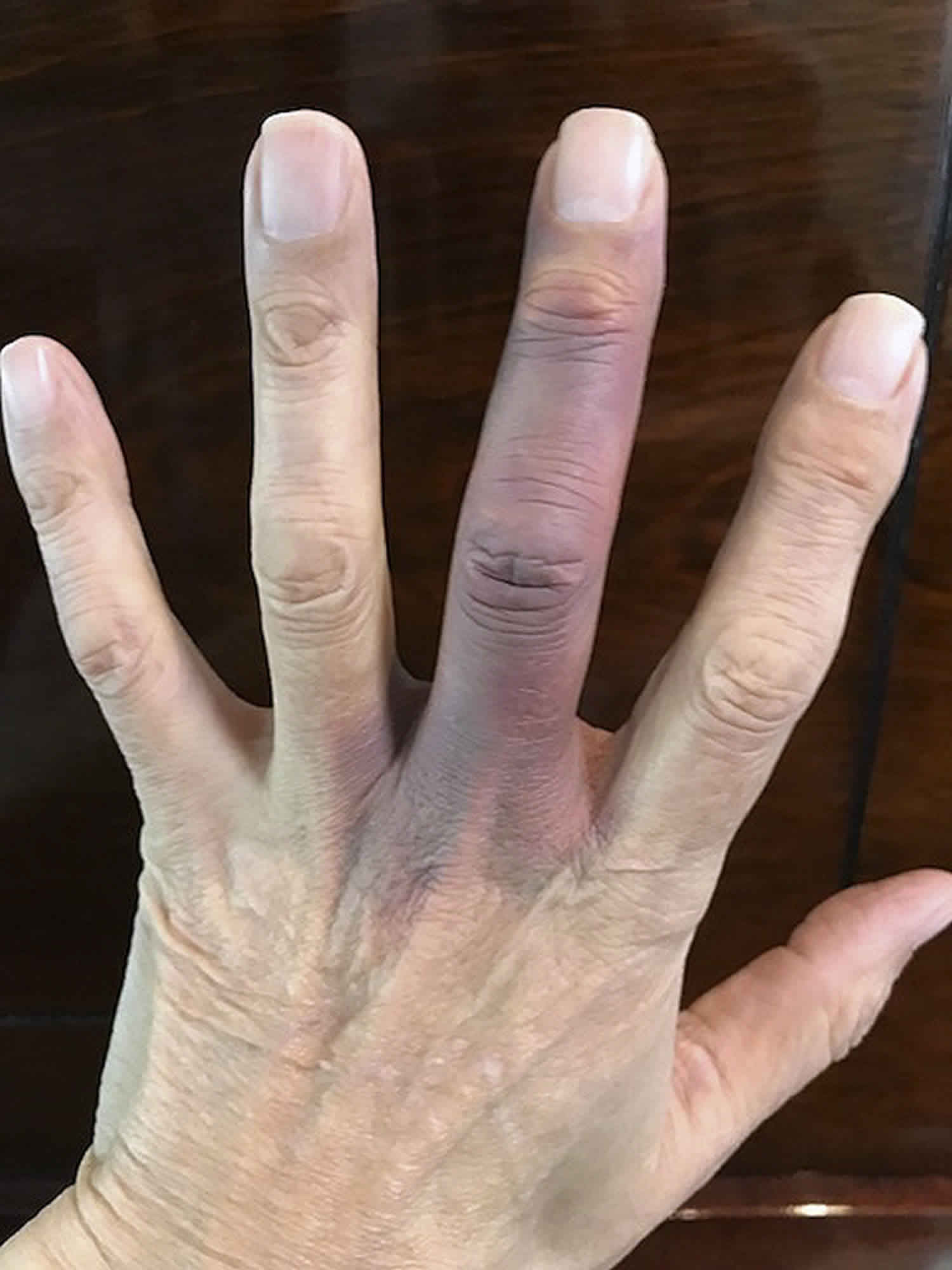 thrombophlebitis-in-fingers