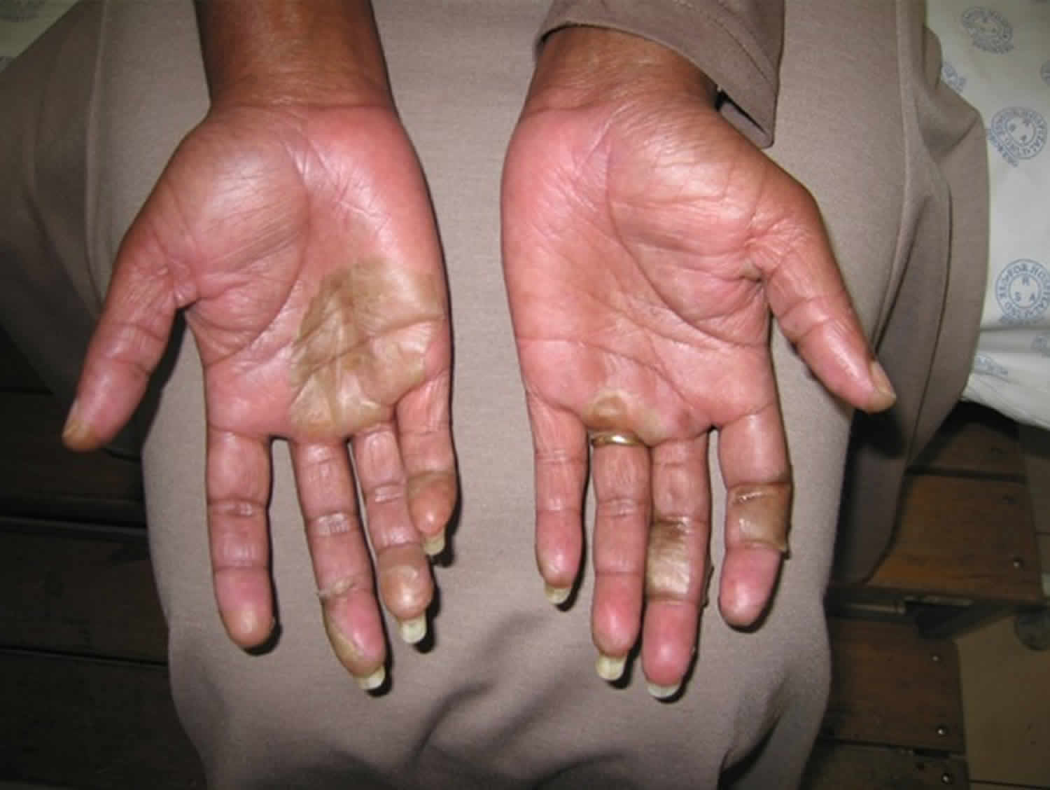 What Immune System Disorder Causes Peeling Skin On Hands