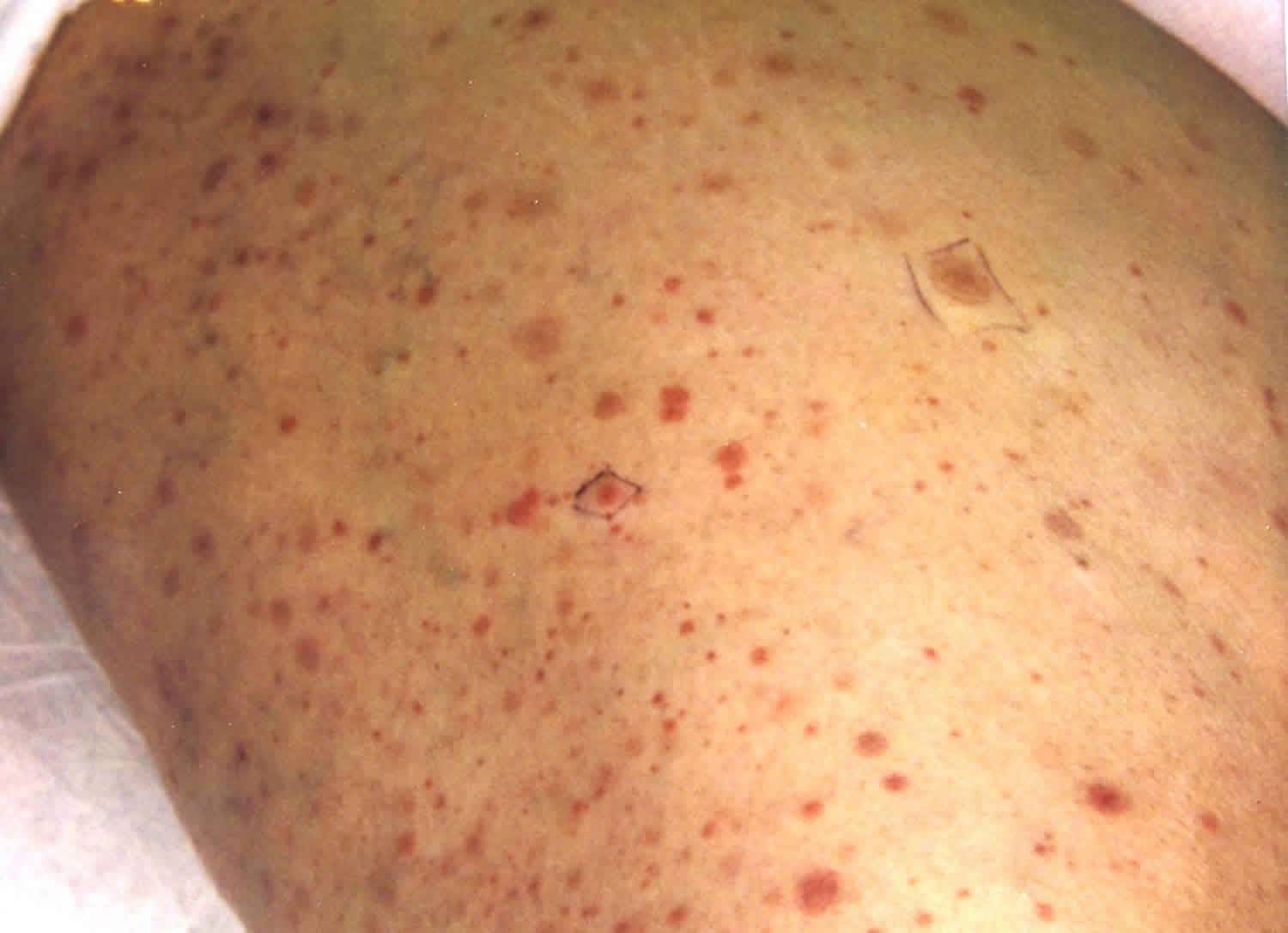 skin pinpoint red spots