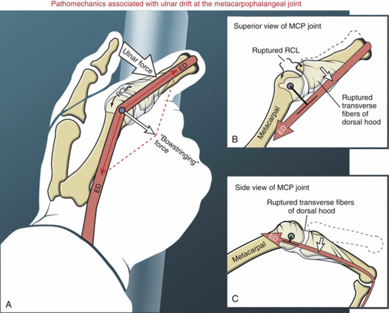 pdf-the-reliability-of-a-qualitative-scoring-system-of-trunk-and-limb