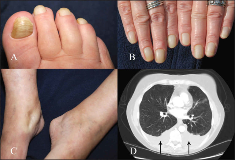 yellow-nail-syndrome-plastic-surgery-key