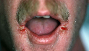 Angular cheilitis