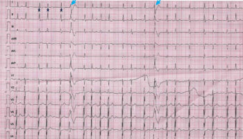 Ashman phenomenon ECG