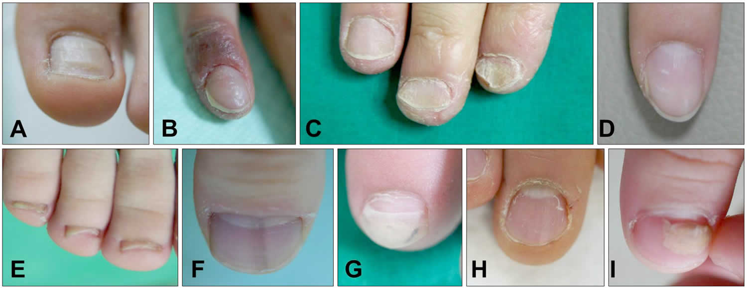 Median Nail Dystrophy of both Thumbs