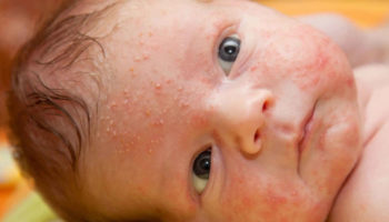 Baby acne