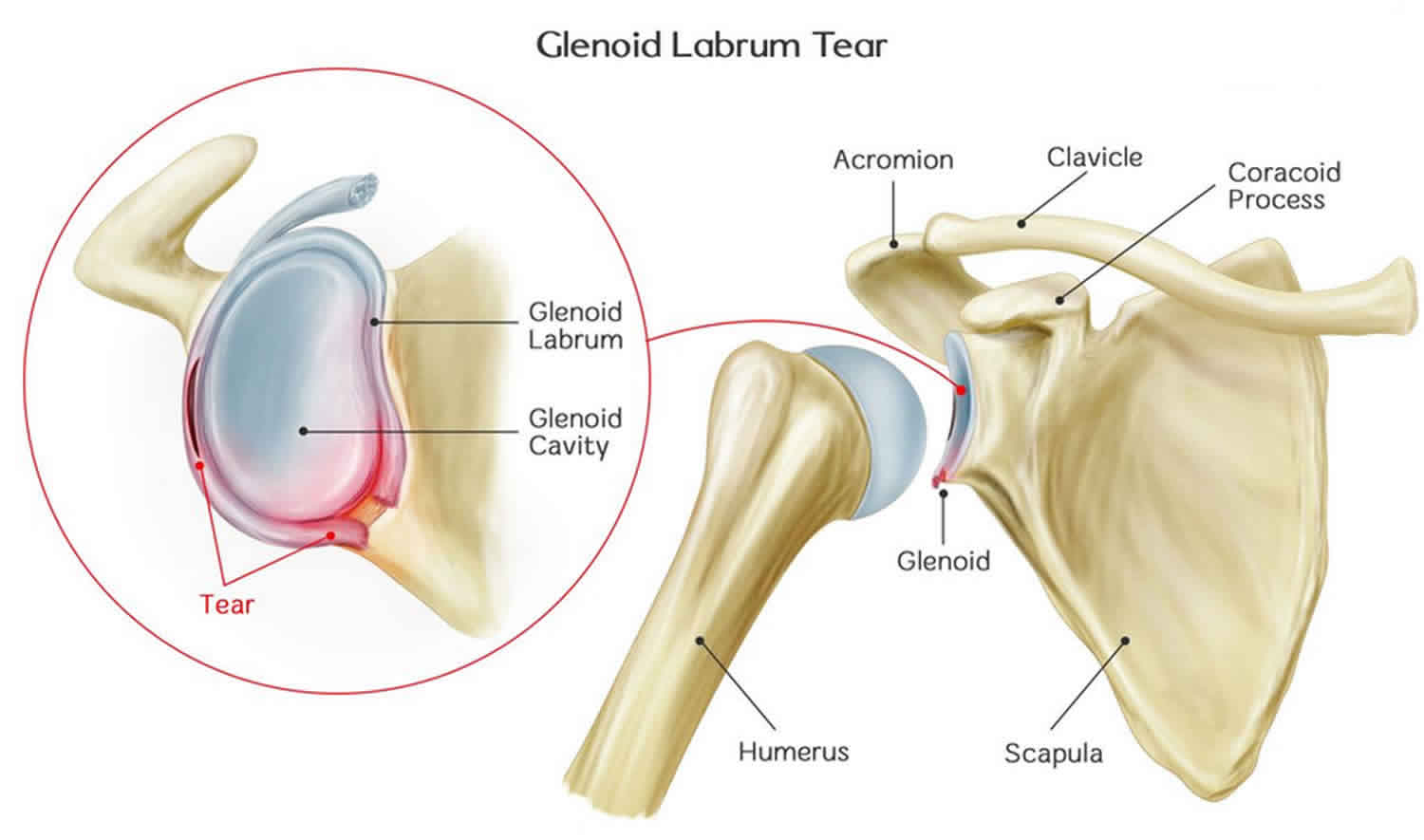 Bankart Lesion Causes Symptoms Diagnosis Treatment