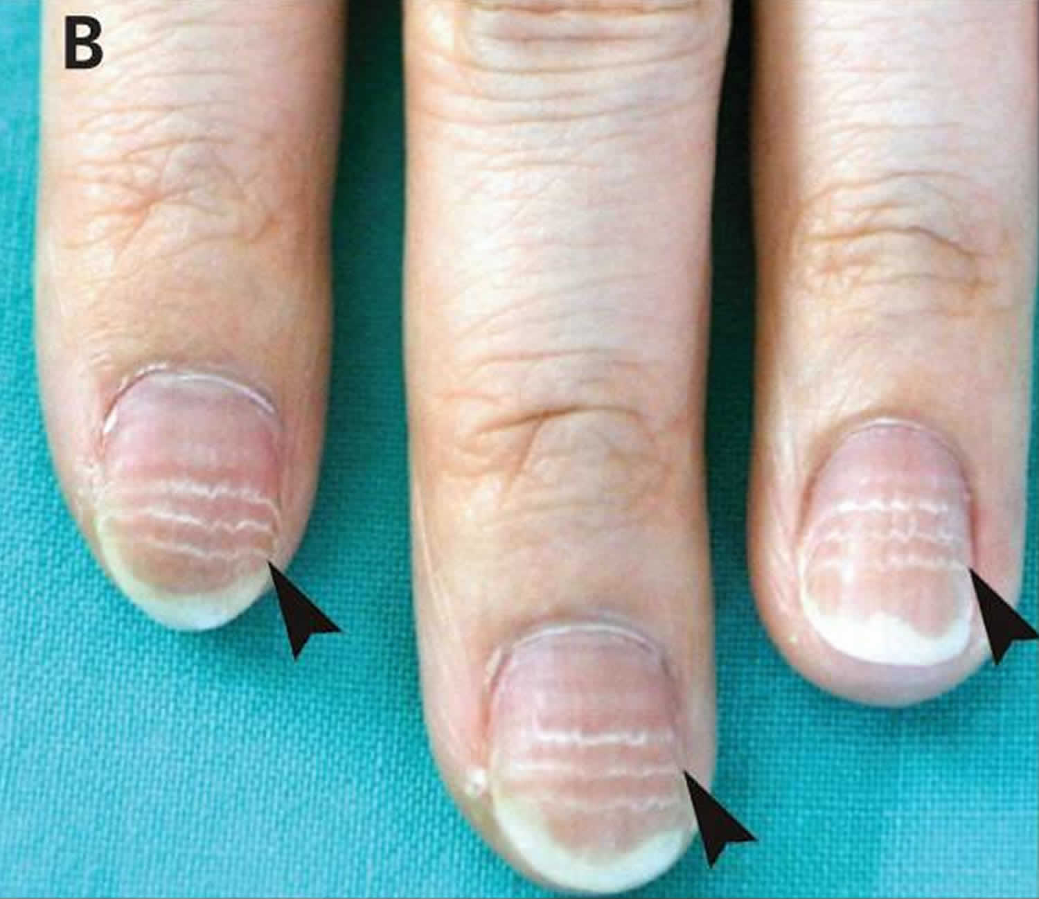 Mees lines fingernails causes, symptoms & treatment