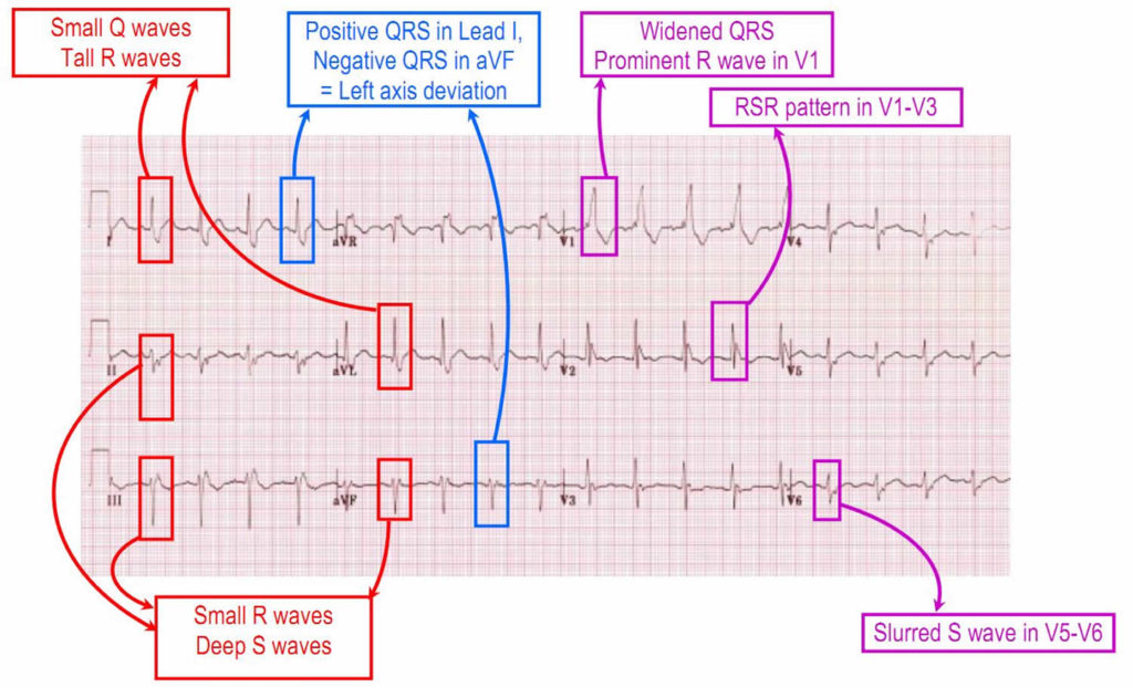 Bifascicular block causes, symptoms, diagnosis & treatment