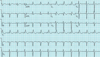 Bifascicular block