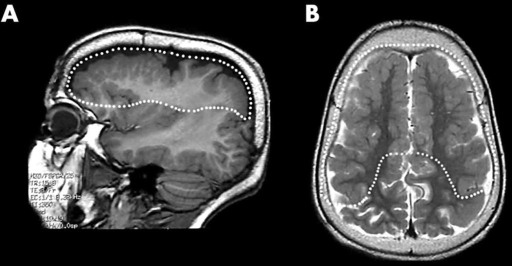 Polymicrogyria causes, symptoms, diagnosis, treatment & prognosis