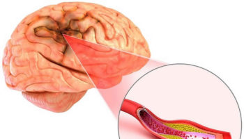 Cerebral atherosclerosis