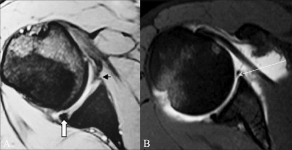 Bankart Lesion Causes Symptoms Diagnosis And Treatment 0487