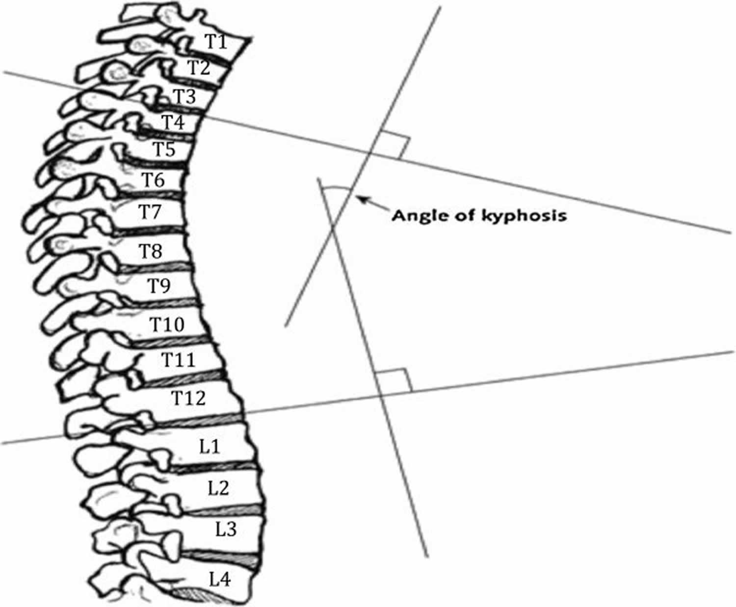 Cobb angle for determining degree of kyphosis