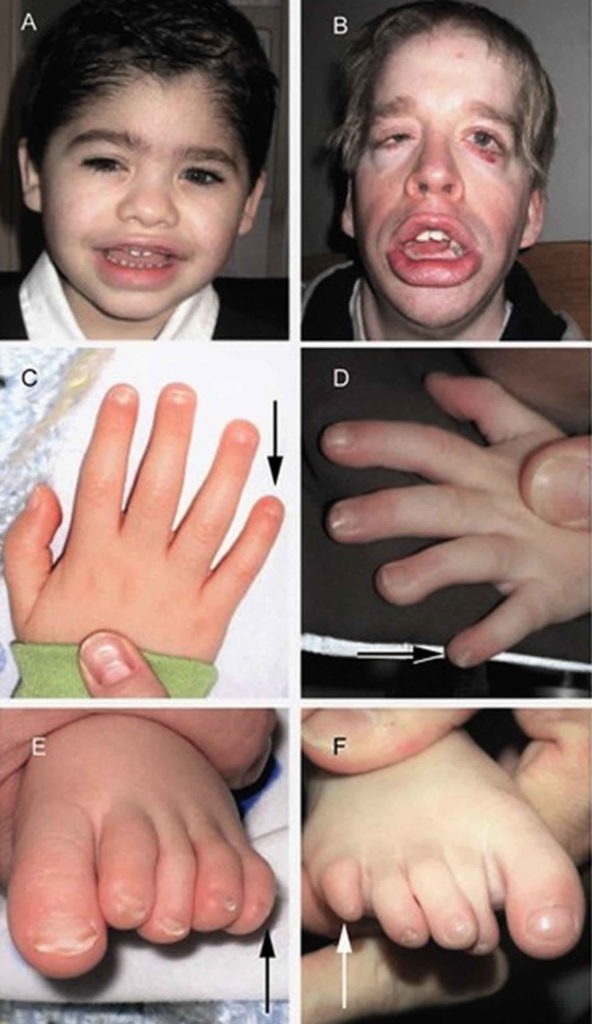 Coffin Siris syndrome causes, symptoms, diagnosis, treatment & prognosis Coffin Siris syndrome causes, symptoms, diagnosis, treatment & prognosis