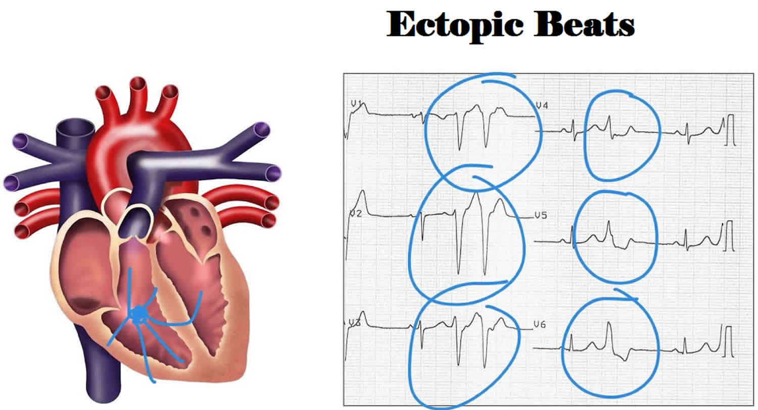 ectopic heartbeat treatment