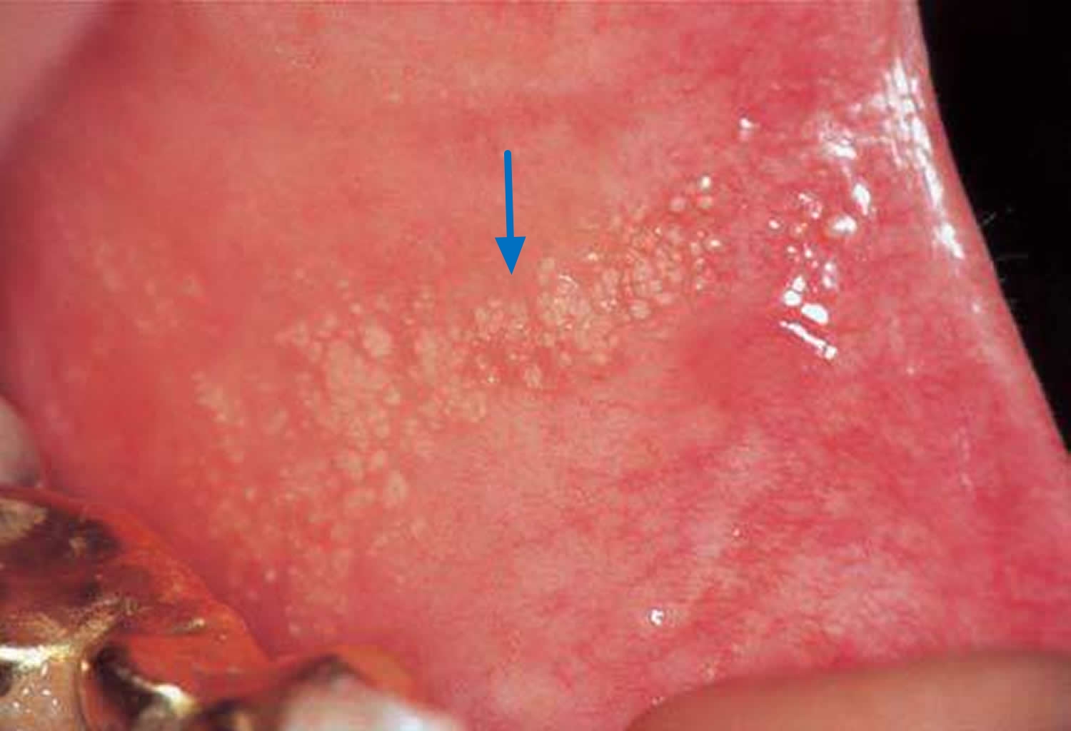 What Are Fordyce Spots and What Causes Them? 