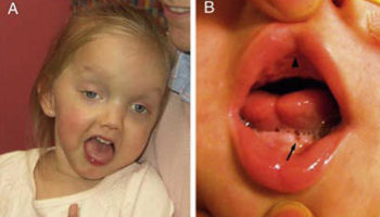 Joubert syndrome