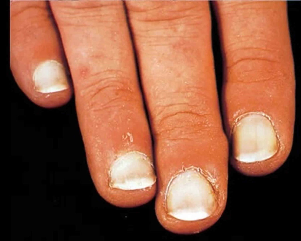 White Spots On Nails Leukonychia Causes Treatment And - vrogue.co