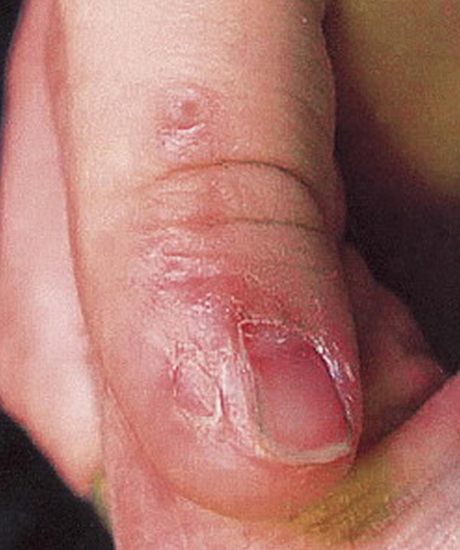 Close-up view of the left index finger showing multiple minute... |  Download Scientific Diagram