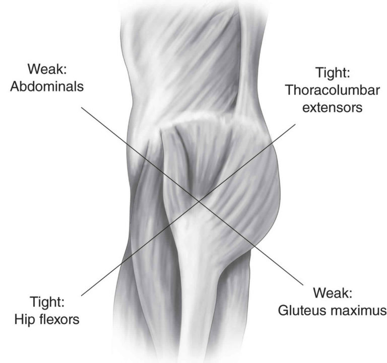 Cross syndrome causes, symptoms, diagnosis, treatment & exercises