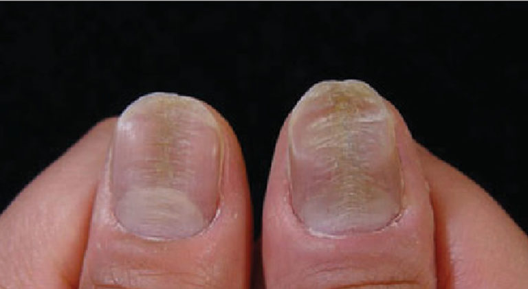 Nail Dystrophy Definition, Causes & Treatment