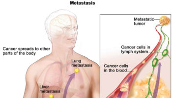 Metastatic adenocarcinoma