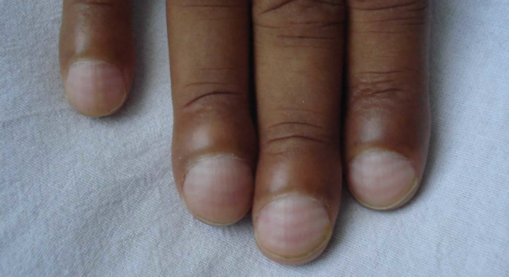 Mees Lines Nails Causes