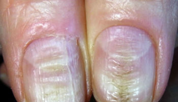Nail dystrophy