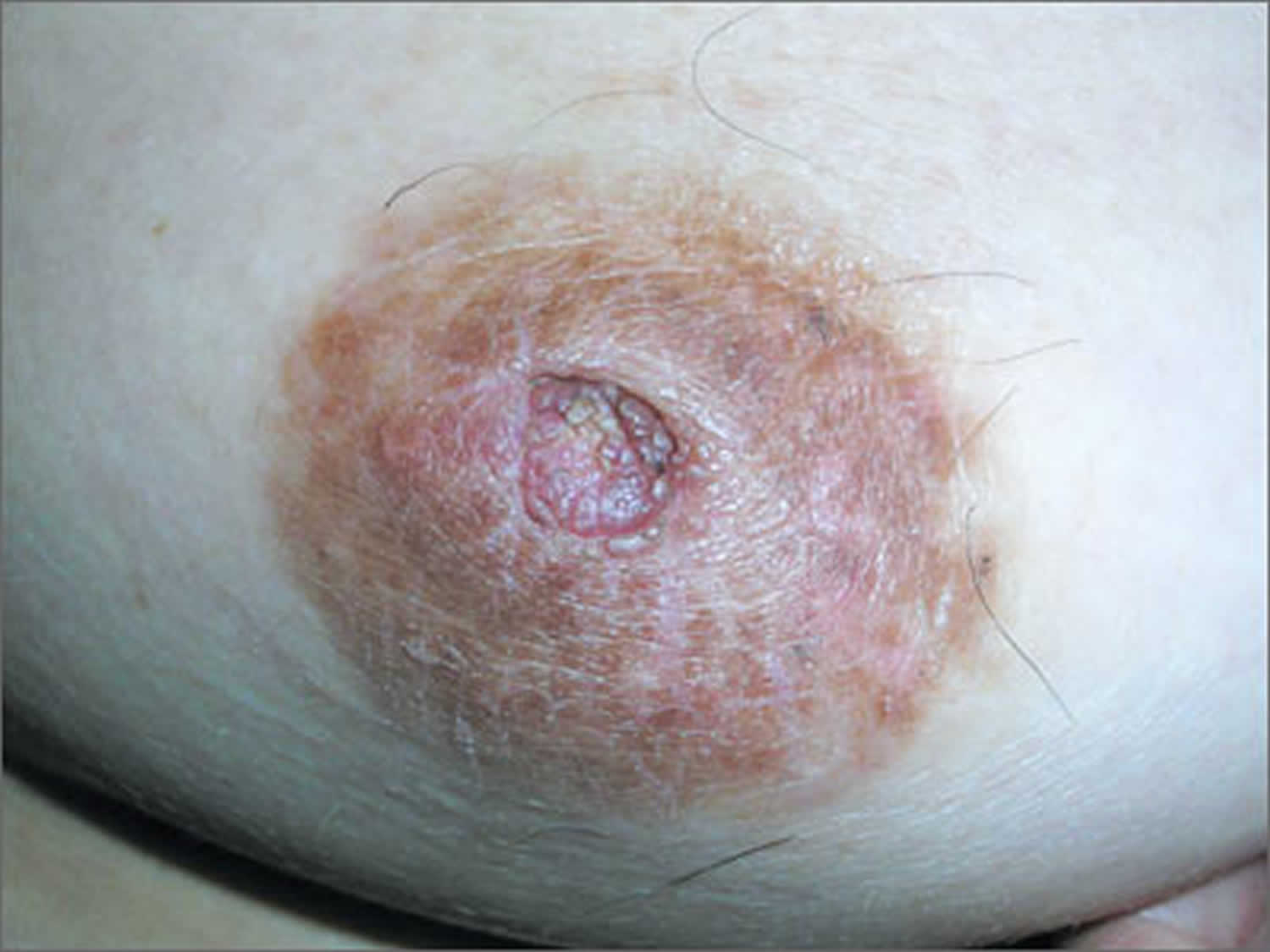 18 Causes Of Itchy Breasts And Nipples You Should Know